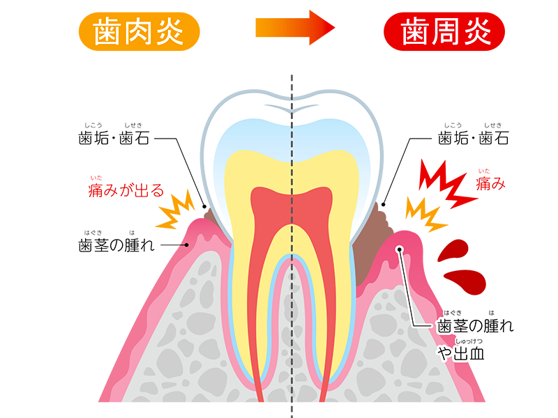 歯肉炎・歯周炎