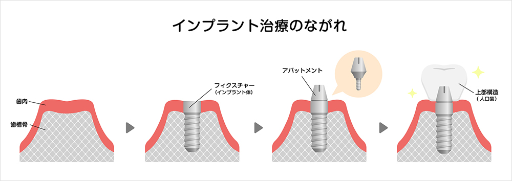インプラント治療の流れ
