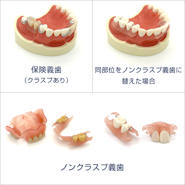 ノンクラスプ義歯